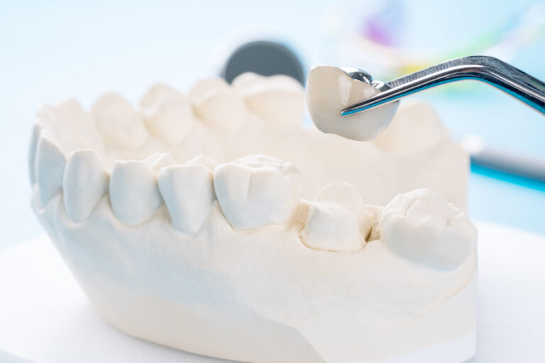 Gros plan sur un modèle d'implant et de couronne dentaire, illustrant les dispositifs concernés par les remboursements de la Sécurité sociale et des mutuelles.