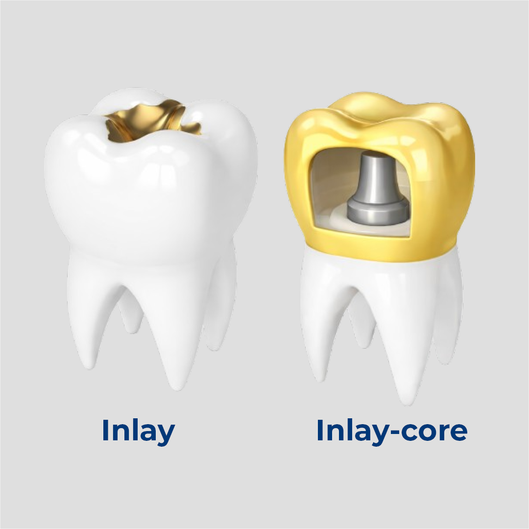 Inlay et inlay-core : comparaison des restaurations dentaires
