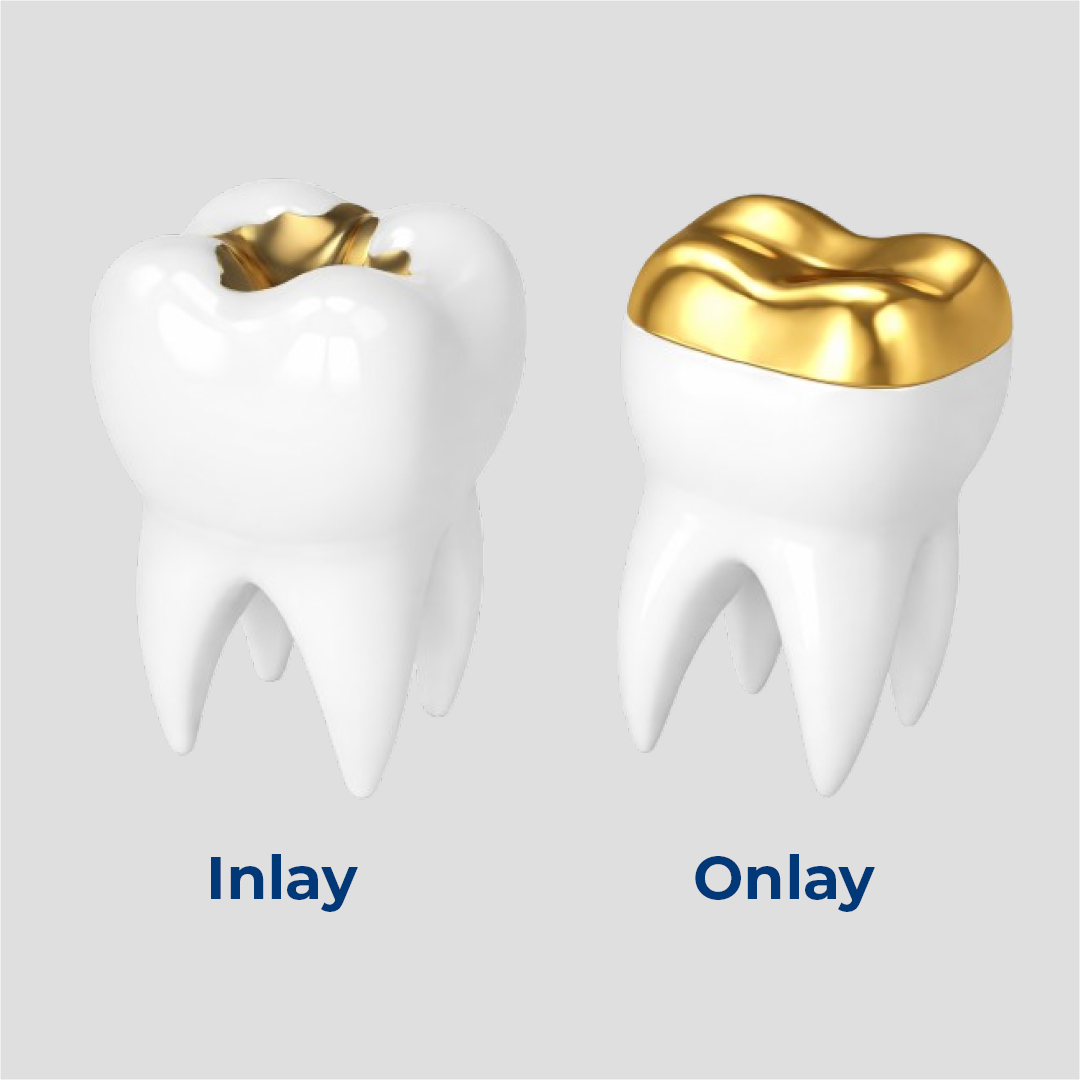 Inlay et onlay : comparaison des restaurations dentaires