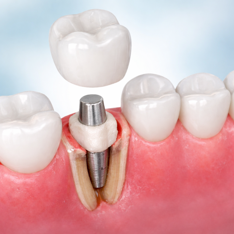 Inlay-core dentaire avec tenon radiculaire servant de support à une future couronne