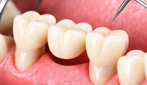 Bridge dentaire fixe utilisé pour remplacer une dent manquante et améliorer la mastication
