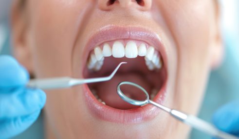 bouche ouverte lors d’une séance de détartrage chez le dentiste Dentiste effectuant un détartrage sur une patiente avec des instruments professionnels