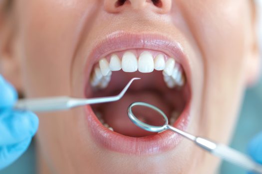 bouche ouverte lors d’une séance de détartrage chez le dentiste Dentiste effectuant un détartrage sur une patiente avec des instruments professionnels
