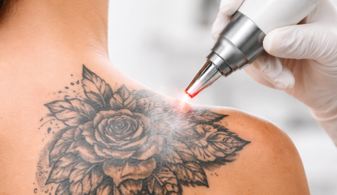 Illustration d’une séance de détatouage au laser réalisée par un professionnel de santé, avec un focus sur les conditions de remboursement par la Sécurité sociale et les mutuelles.