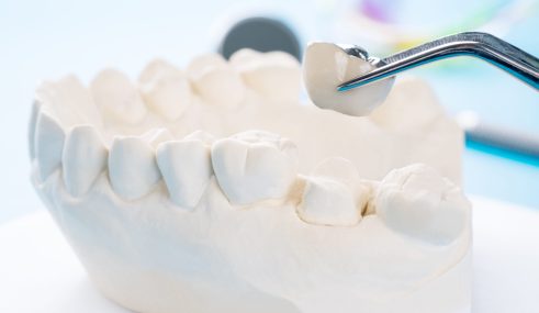 Gros plan sur un modèle d’implant et de couronne dentaire, illustrant les dispositifs concernés par les remboursements de la Sécurité sociale et des mutuelles. Gros plan sur un modèle d'implant et de couronne dentaire, illustrant les dispositifs concernés par les remboursements de la Sécurité sociale et des mutuelles.